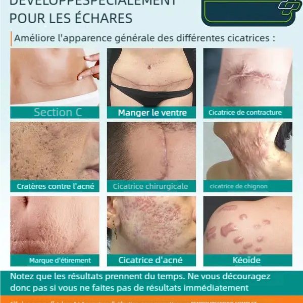 Reparis™ Le Spray anti-cicatrices avancé pour tous types de cicatrices