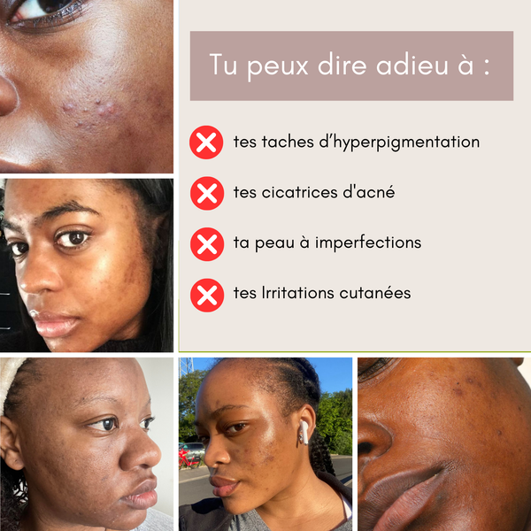 KURMEA+™ Pads anti-imperfections au Curcuma et à l’Acide Kojique