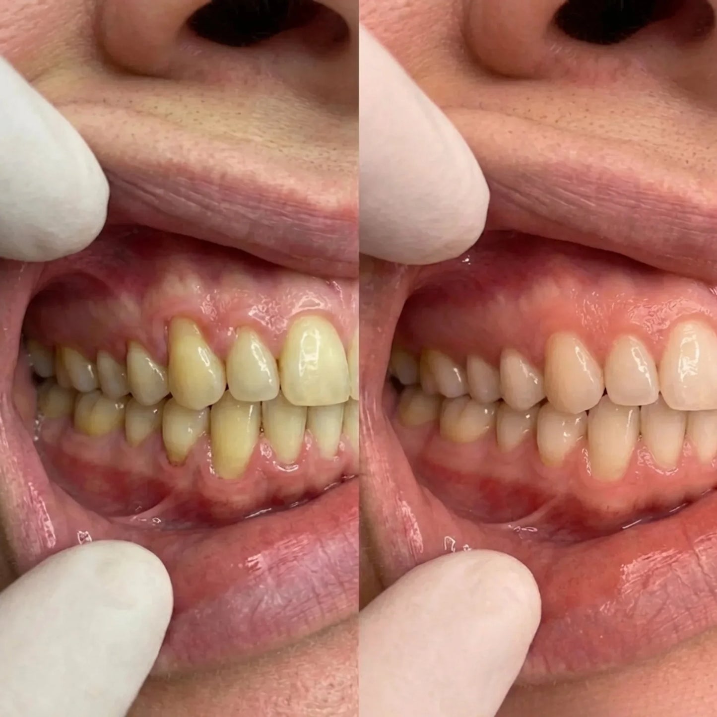 CollaGum™ — Des gencives plus saines chaque jour